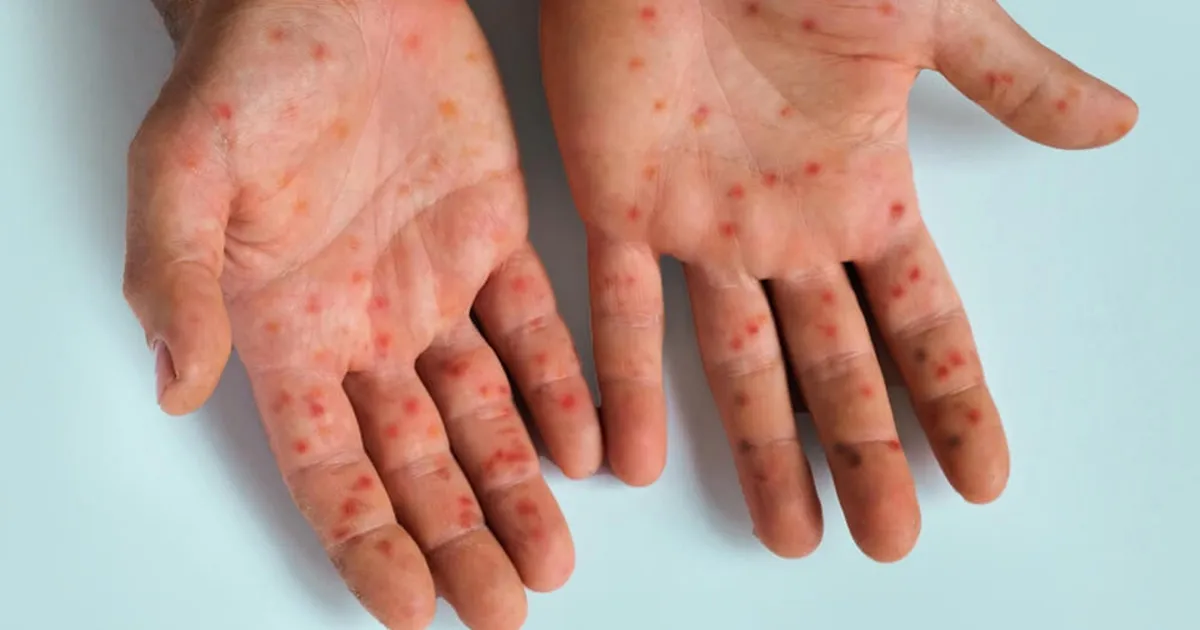 Measles patient
