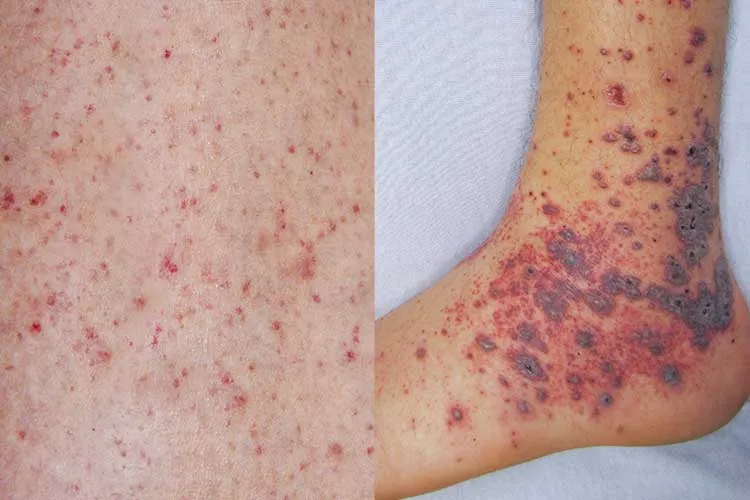 Meningococcal rash (Photo/Ausmed)