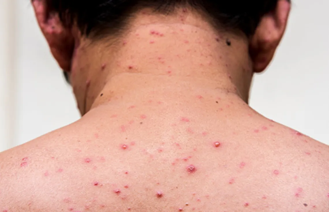 A patient with Measles