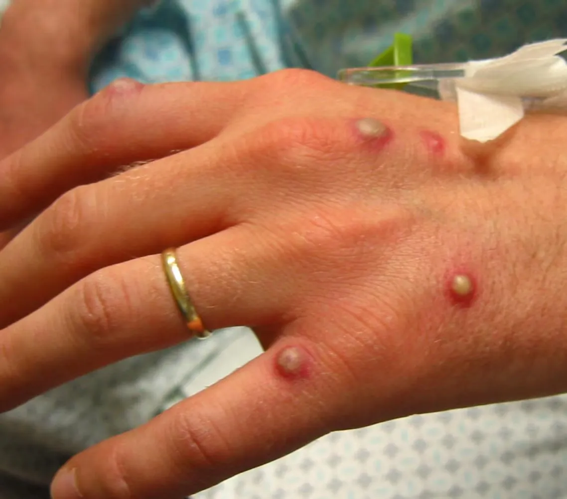Vesicular rash of Mpox (Photo/medscape)