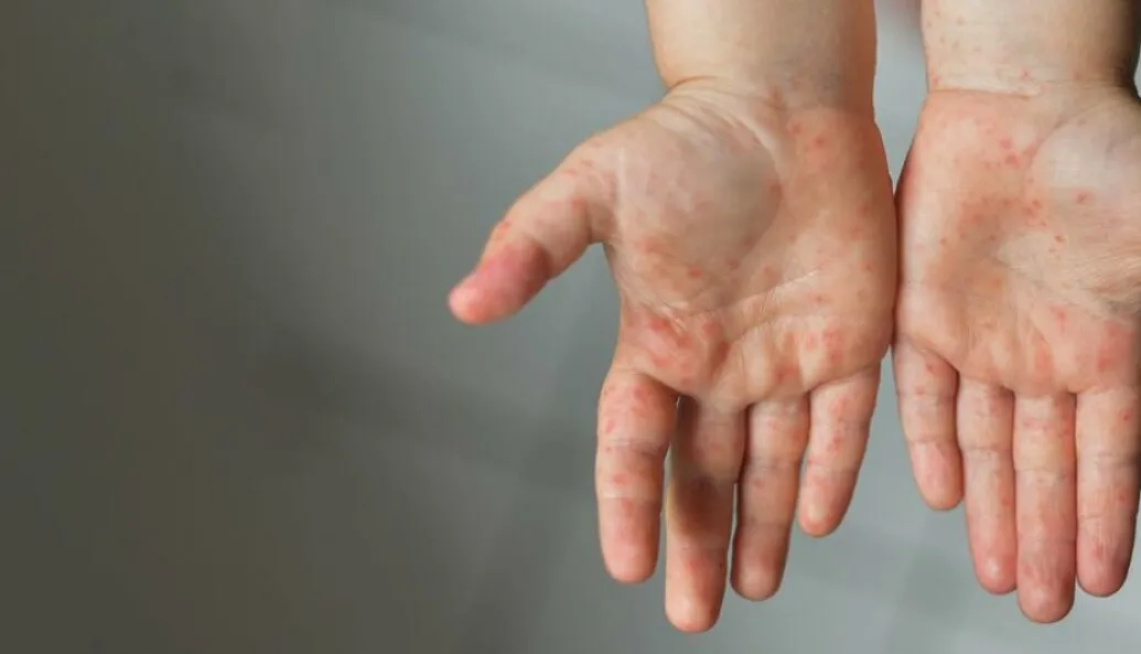 Measles rash on hands