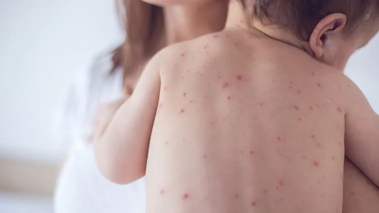 Child diagnosed with Measles